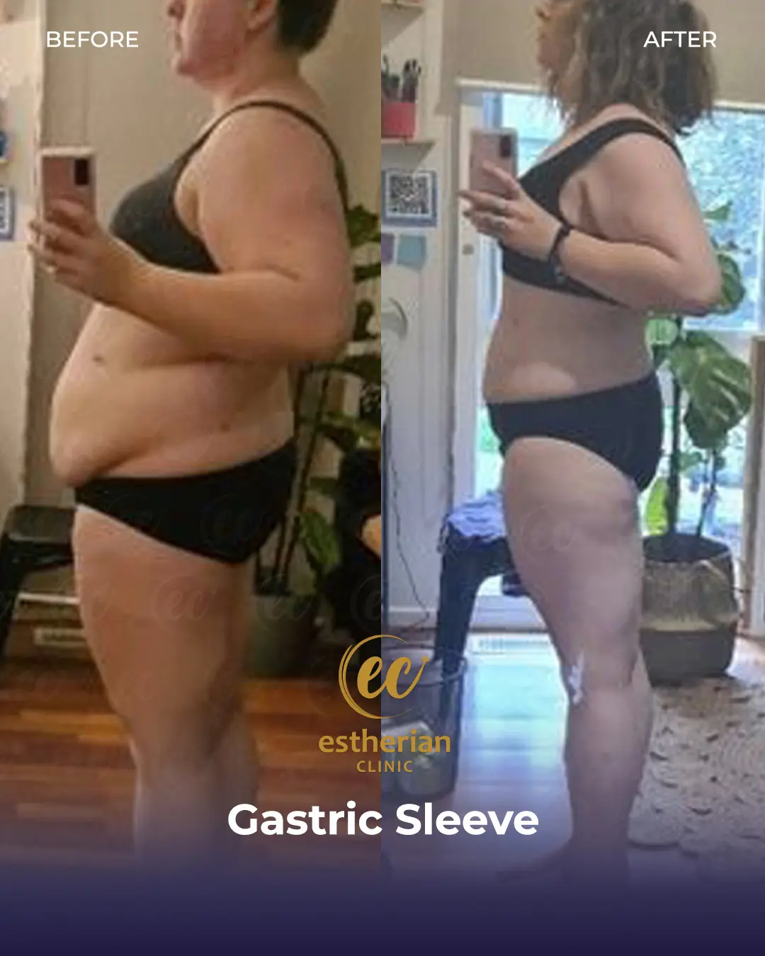 Gastric Sleeve Surgery (Bariatric Surgery) Before-and-after Real Patient Transformation by the Estherian Clinic