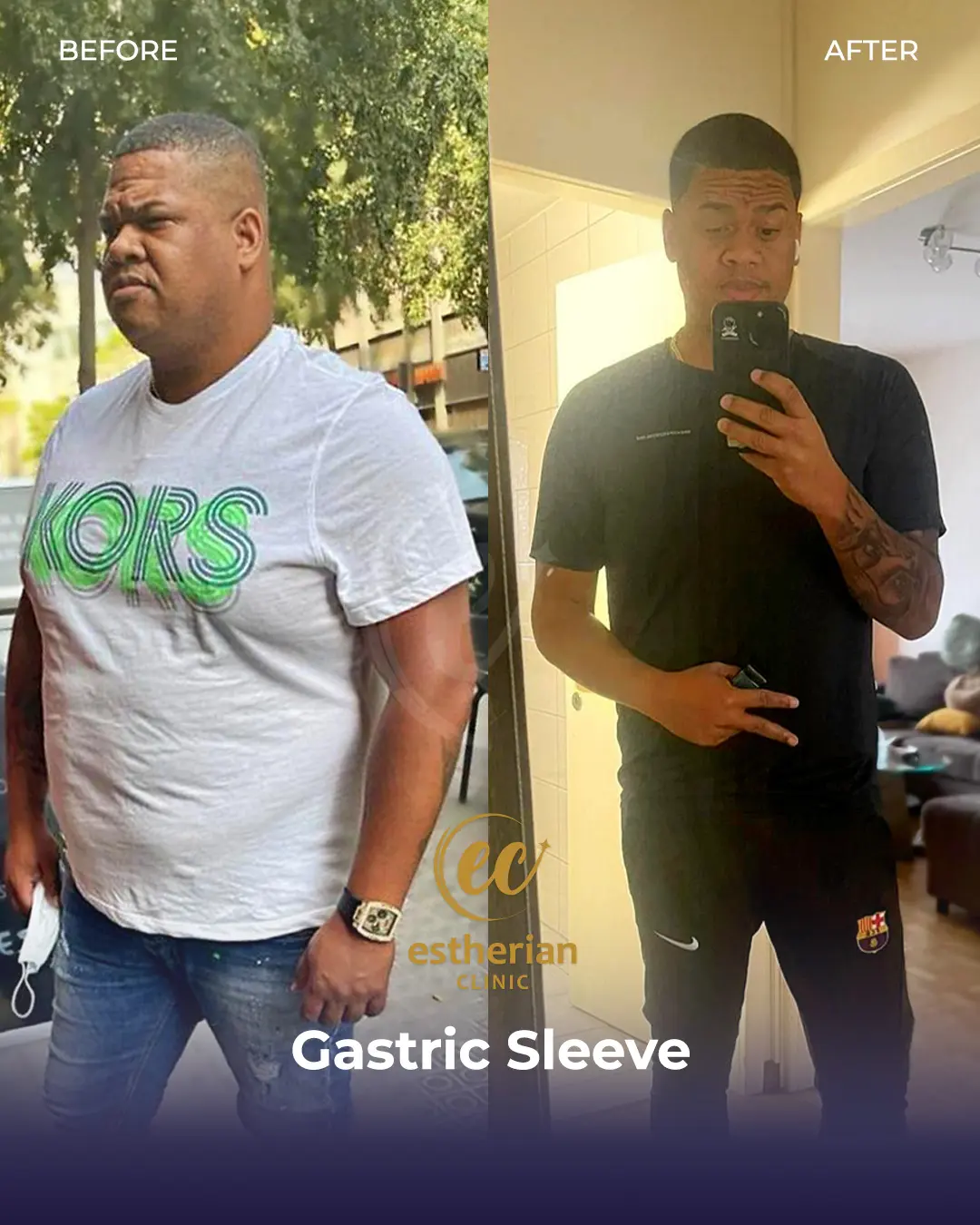 Gastric Sleeve Surgery (Bariatric Surgery) Before-and-after Real Patient Transformation by the Estherian Clinic
