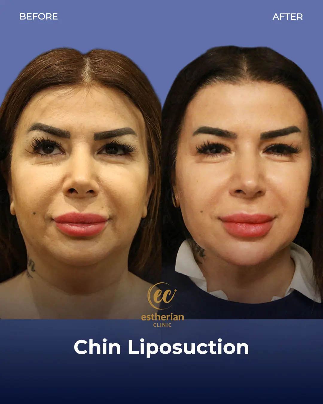 Chin Liposuction Real Patient Transformation by the Estherian Clinic