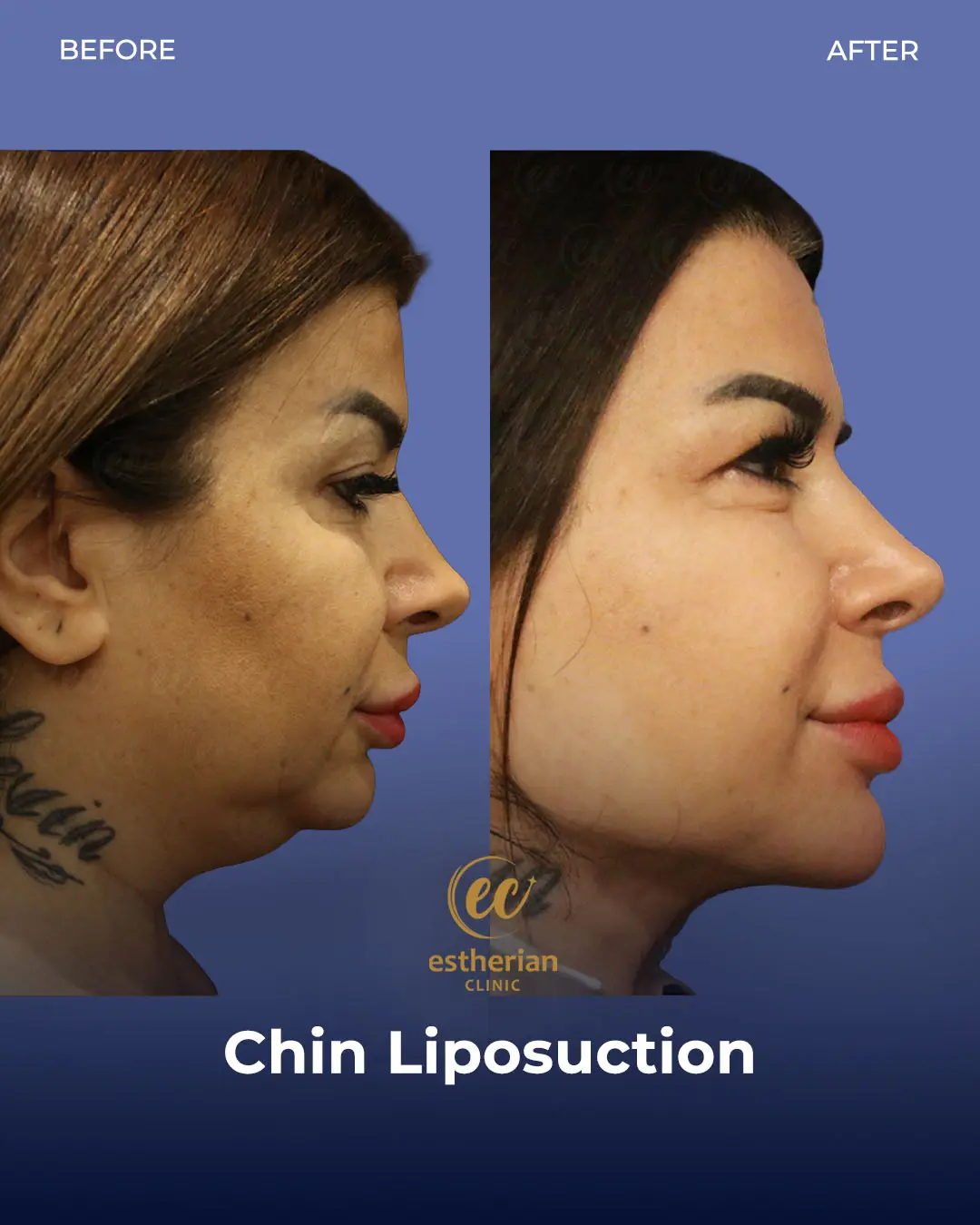 Chin Liposuction Real Patient Transformation by the Estherian Clinic