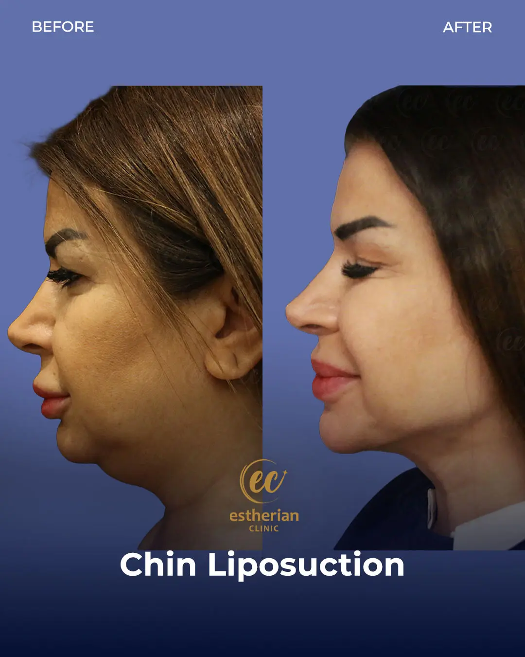 Chin Liposuction Real Patient Transformation by the Estherian Clinic