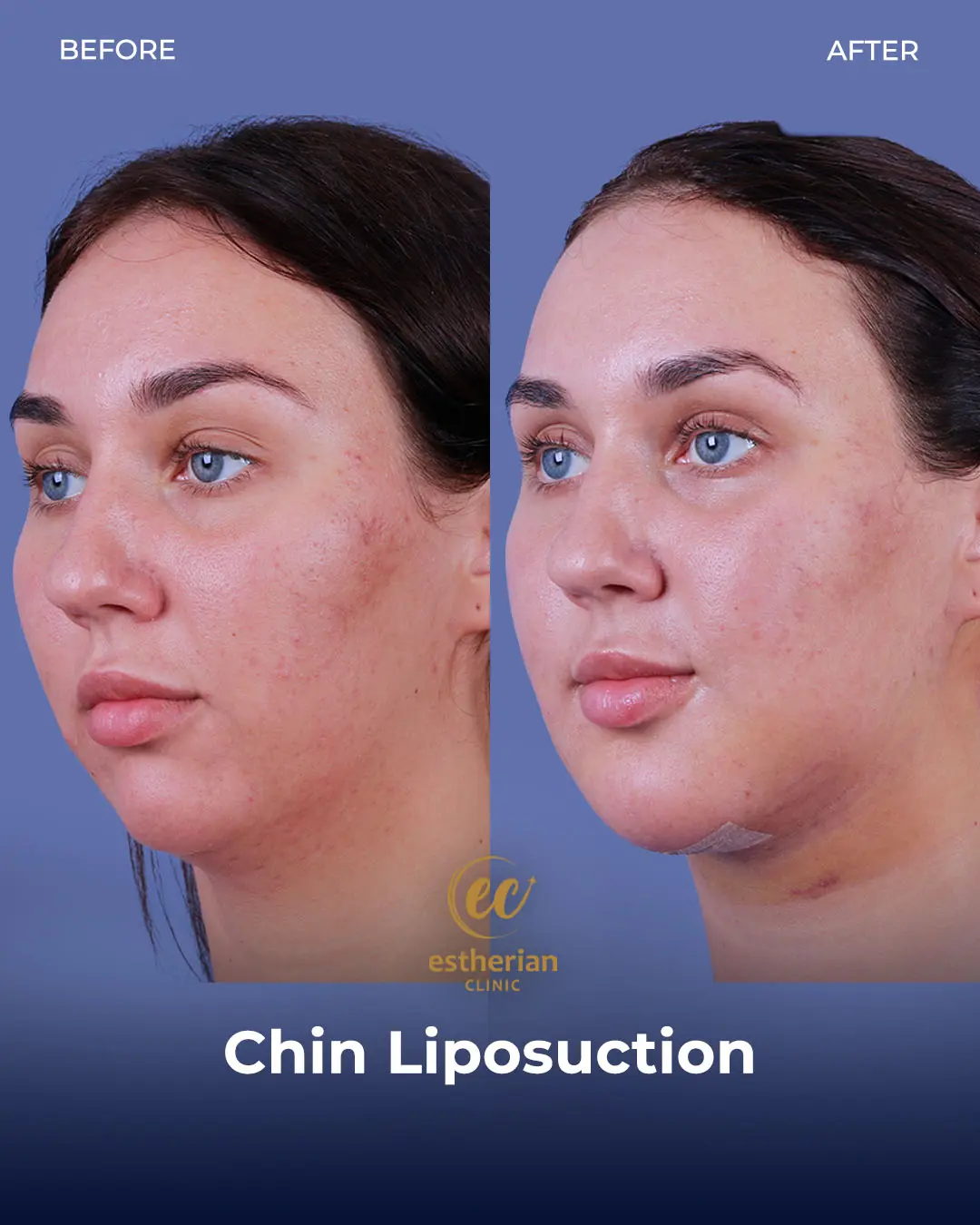 Chin Liposuction Real Patient Transformation by the Estherian Clinic