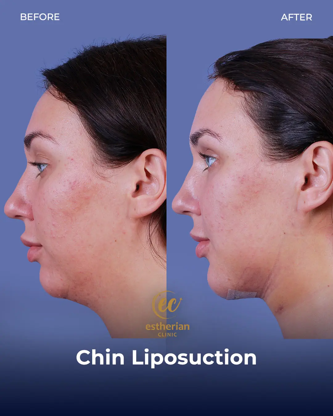 Chin Liposuction Real Patient Transformation by the Estherian Clinic