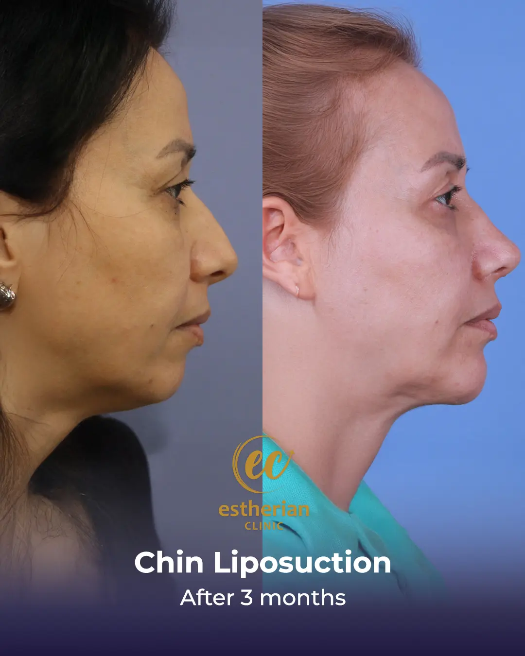 Chin Liposuction Real Patient Transformation by the Estherian Clinic