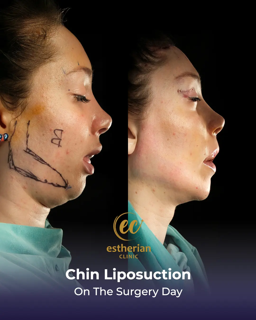 Chin Liposuction Real Patient Transformation by the Estherian Clinic