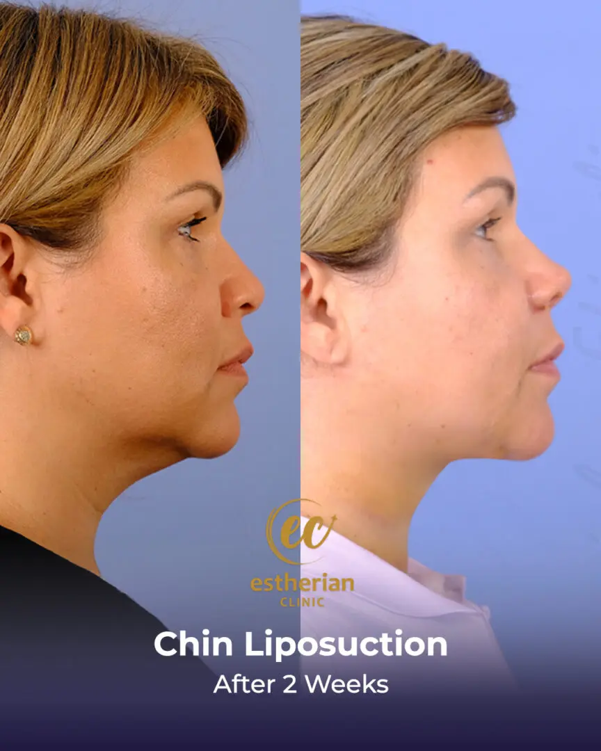 Chin Liposuction Real Patient Transformation by the Estherian Clinic