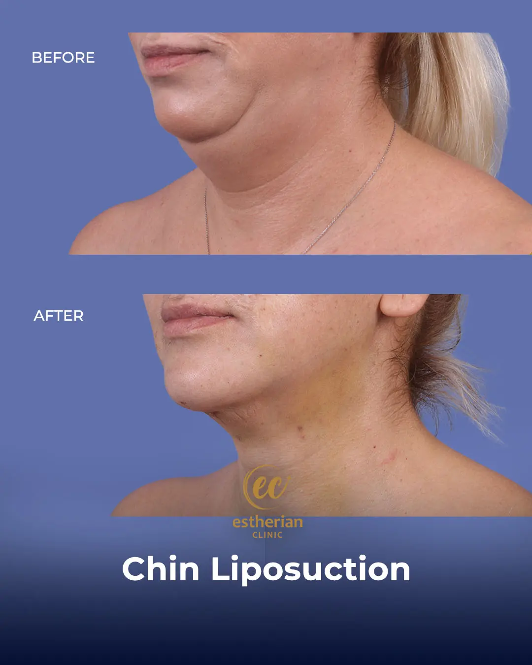 Chin Liposuction Real Patient Transformation by the Estherian Clinic