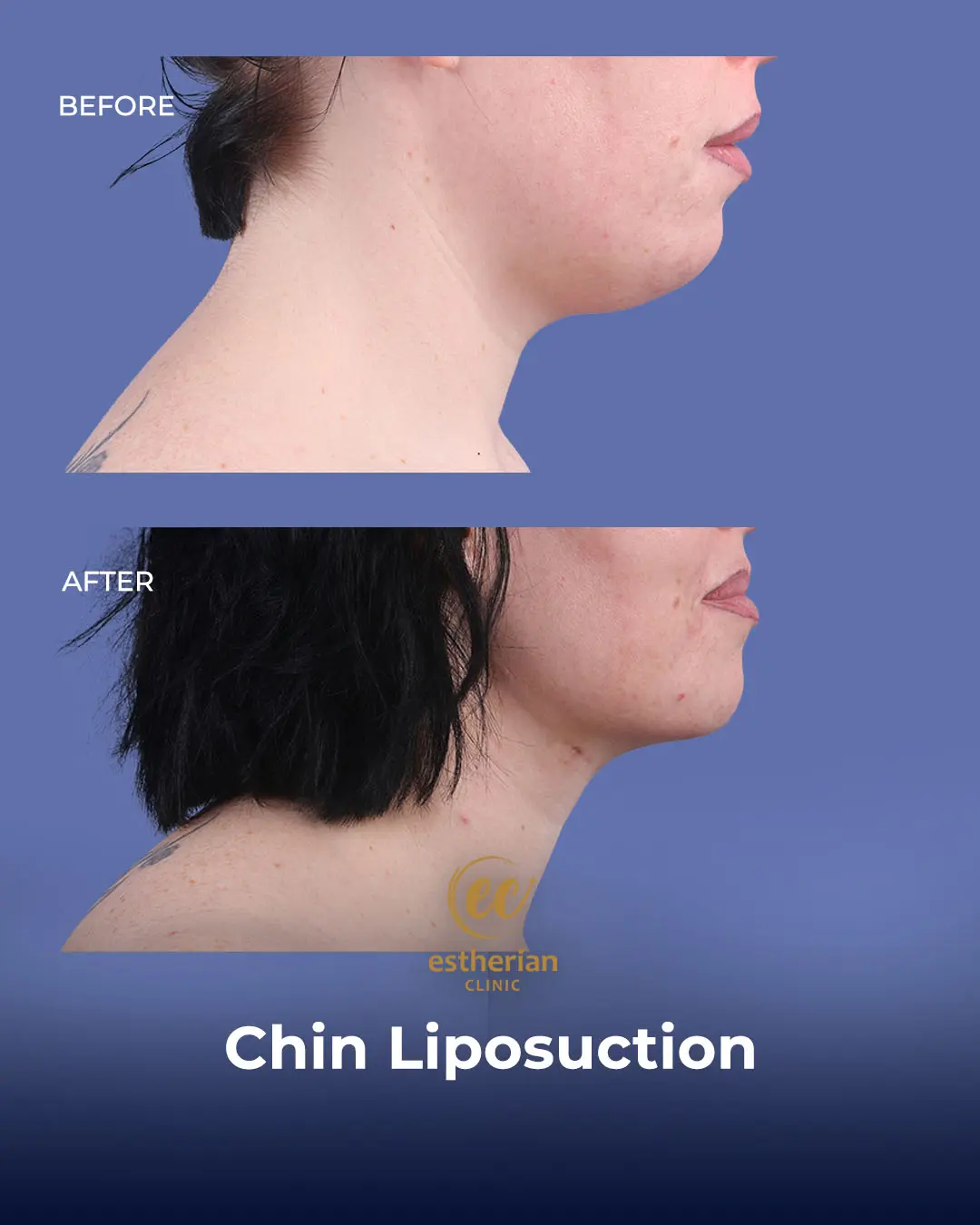 Chin Liposuction Real Patient Transformation by the Estherian Clinic