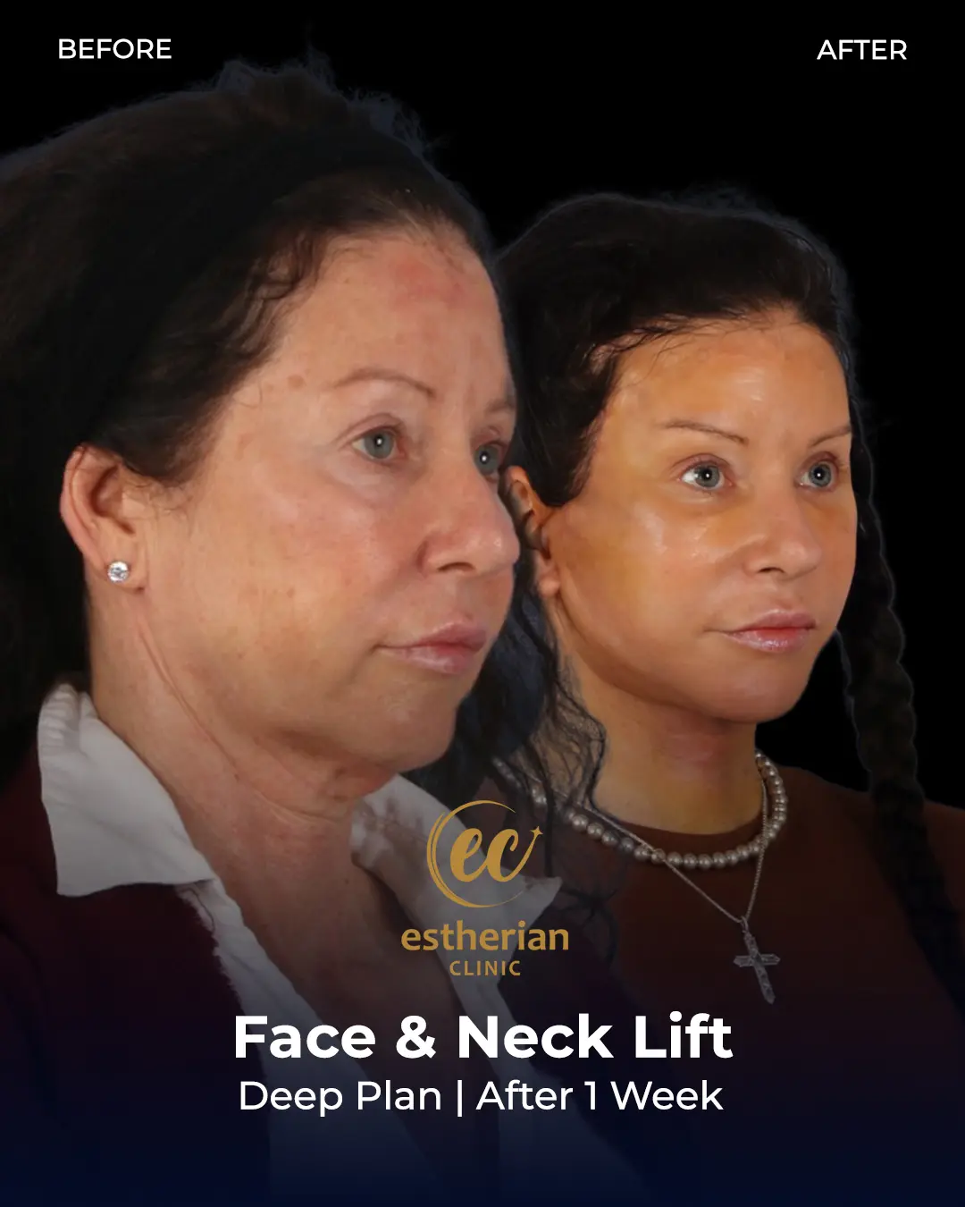 Face and Neck Lift Before and After Gallery by the Estherian Clinic