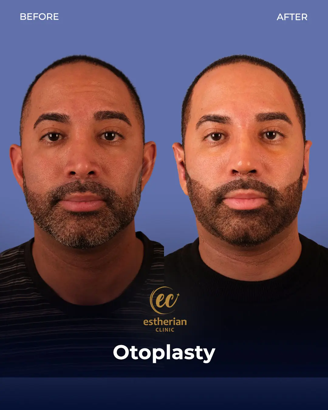 Otoplasty Before and After by the Estherian Clinic