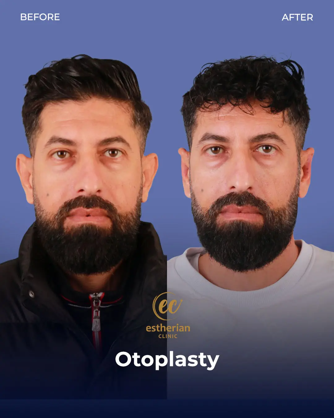 Otoplasty Before and After by the Estherian Clinic