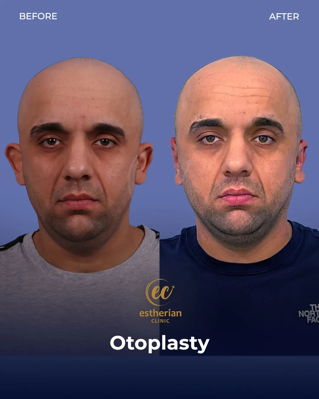 Otoplasty Before and After by the Estherian Clinic