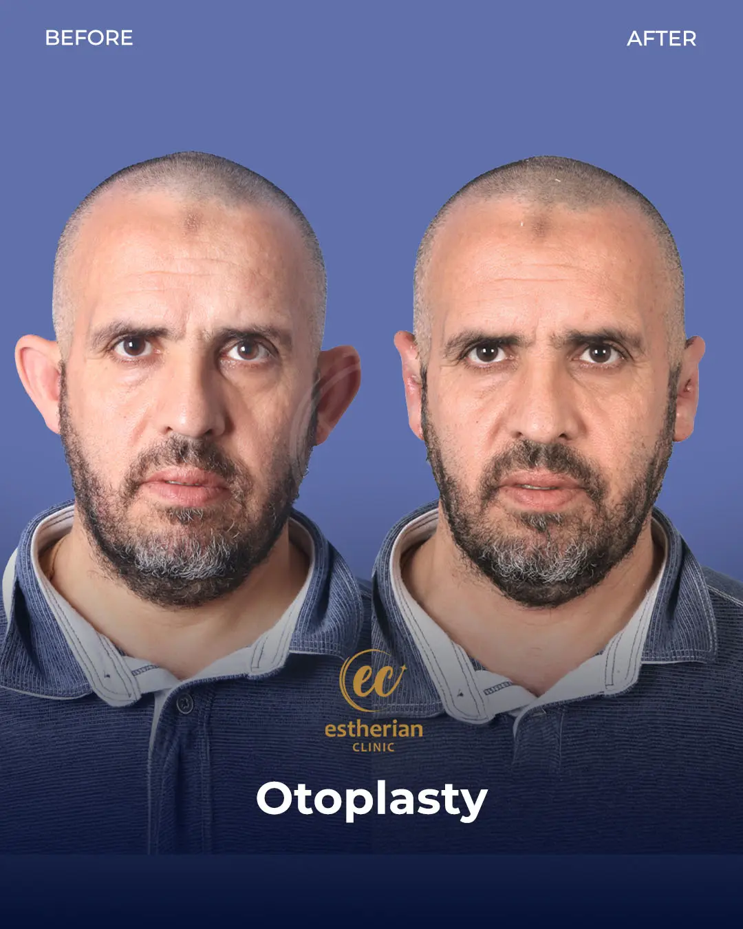 Otoplasty Before and After by the Estherian Clinic