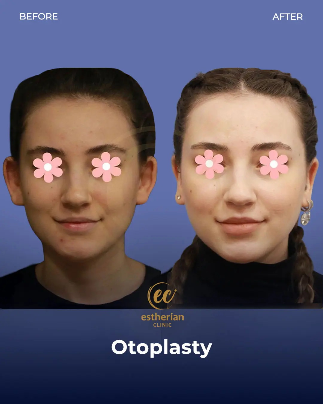 Otoplasty Before and After by the Estherian Clinic