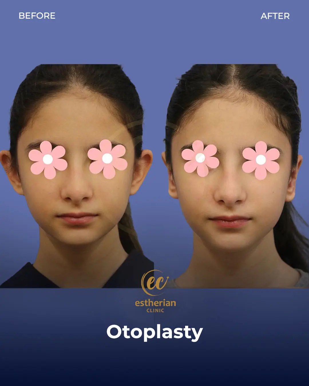 Otoplasty Before and After by the Estherian Clinic