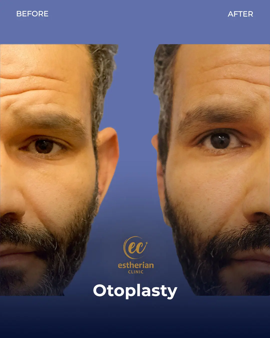 Otoplasty Before and After by the Estherian Clinic