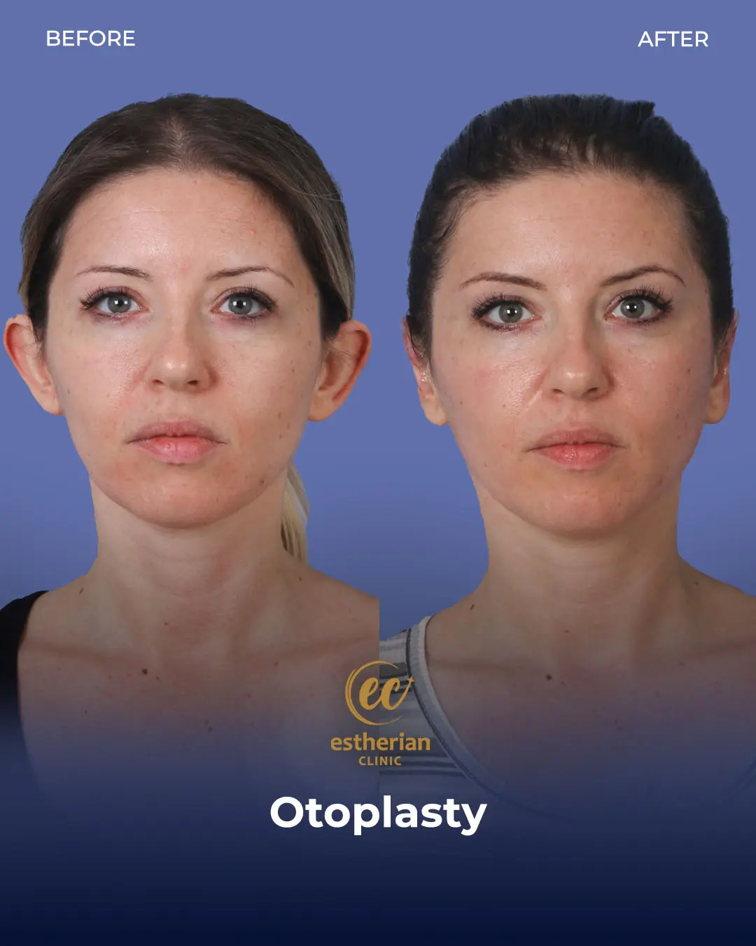 Otoplasty Before and After by the Estherian Clinic