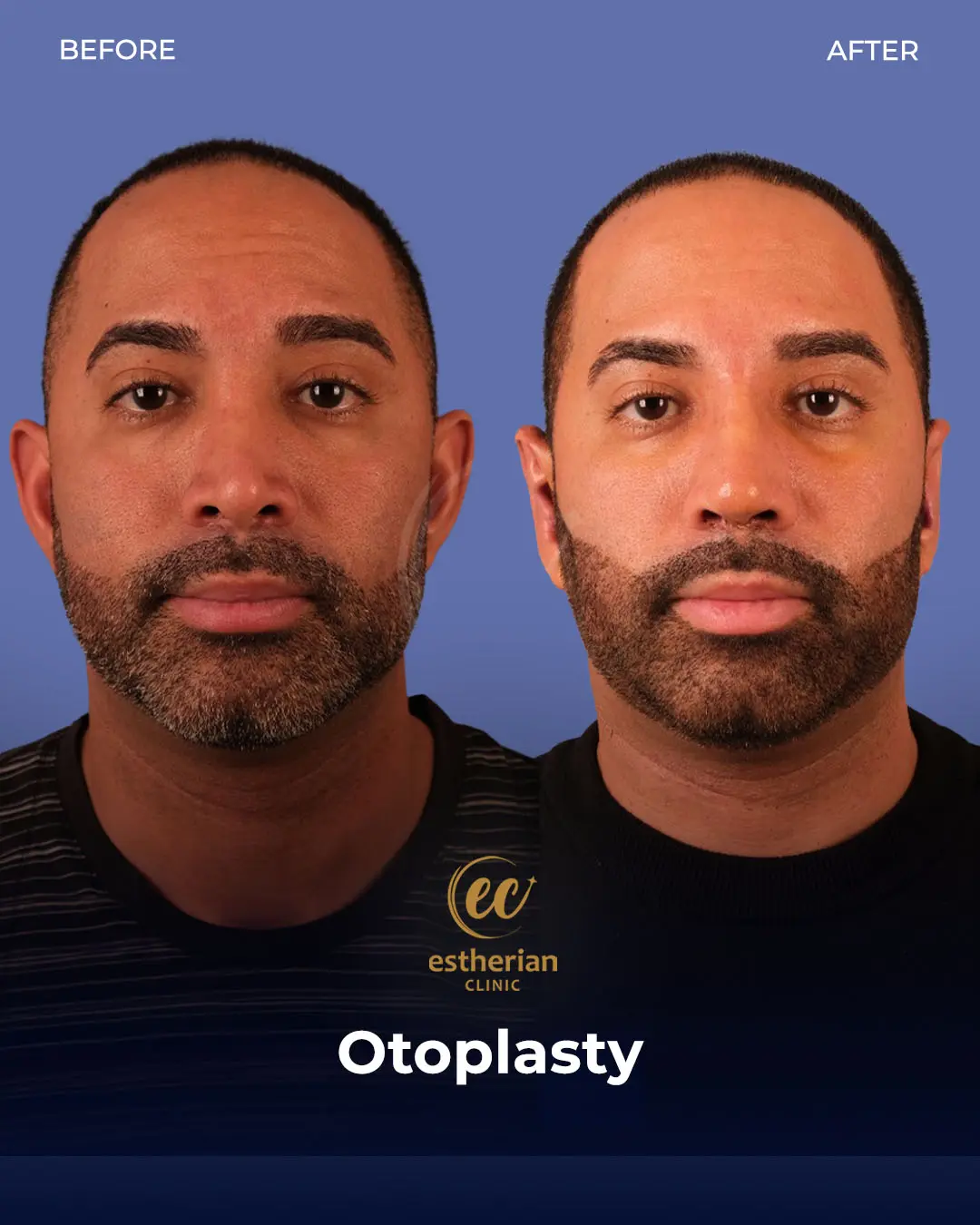 Otoplasty Before and After by the Estherian Clinic