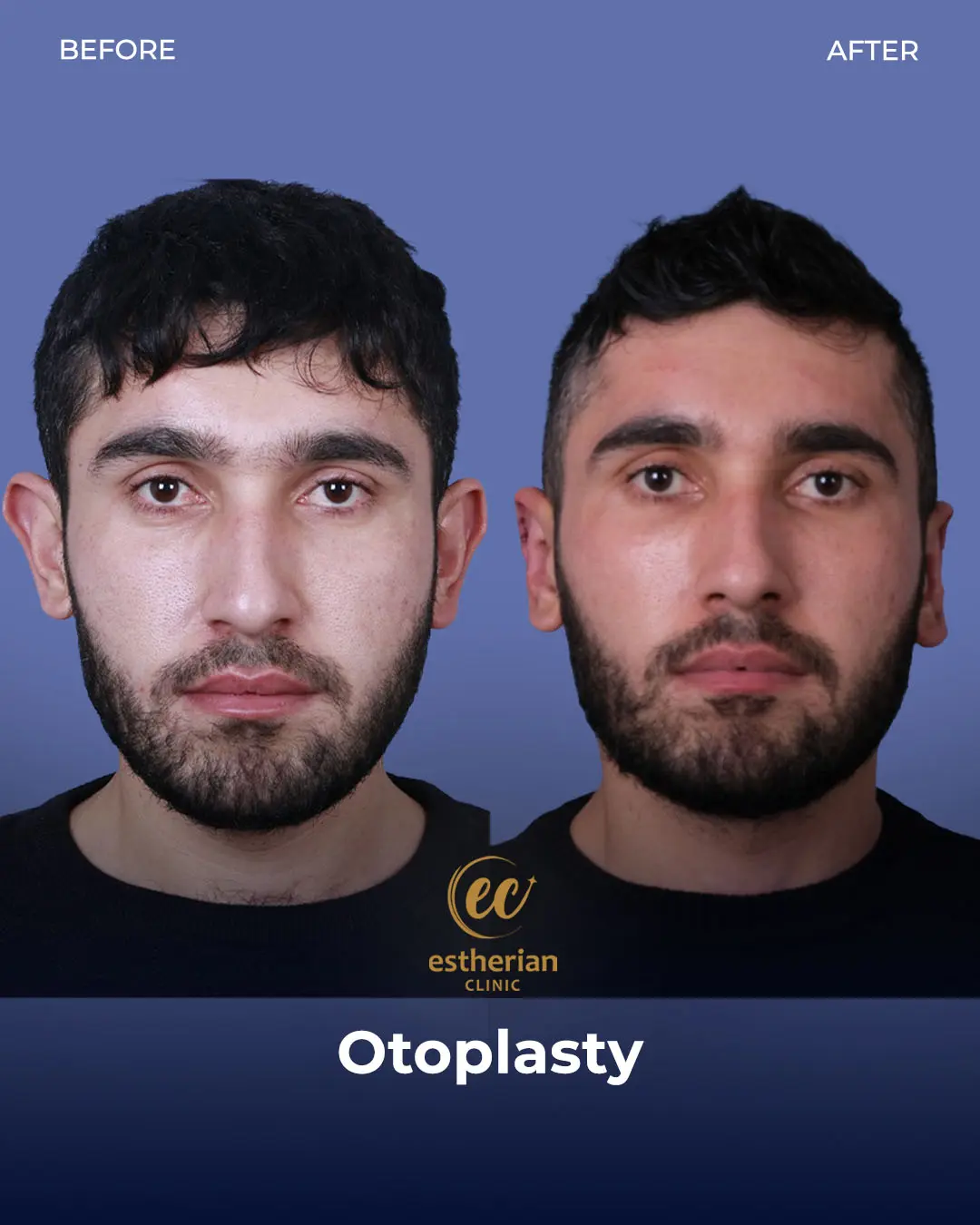 Otoplasty Before and After by the Estherian Clinic