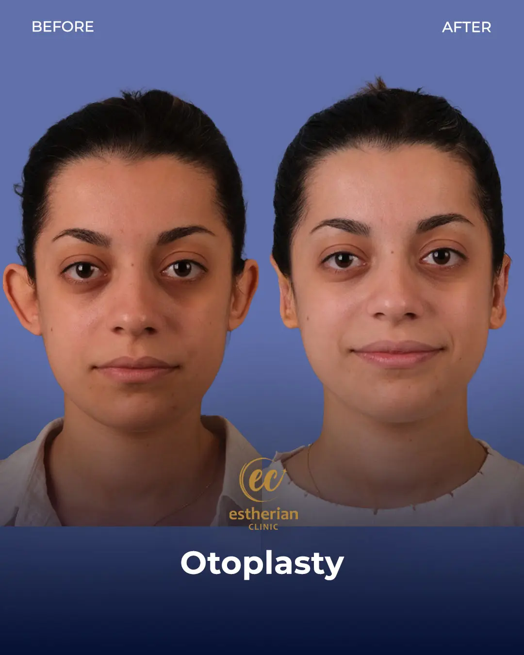 Otoplasty Before and After by the Estherian Clinic