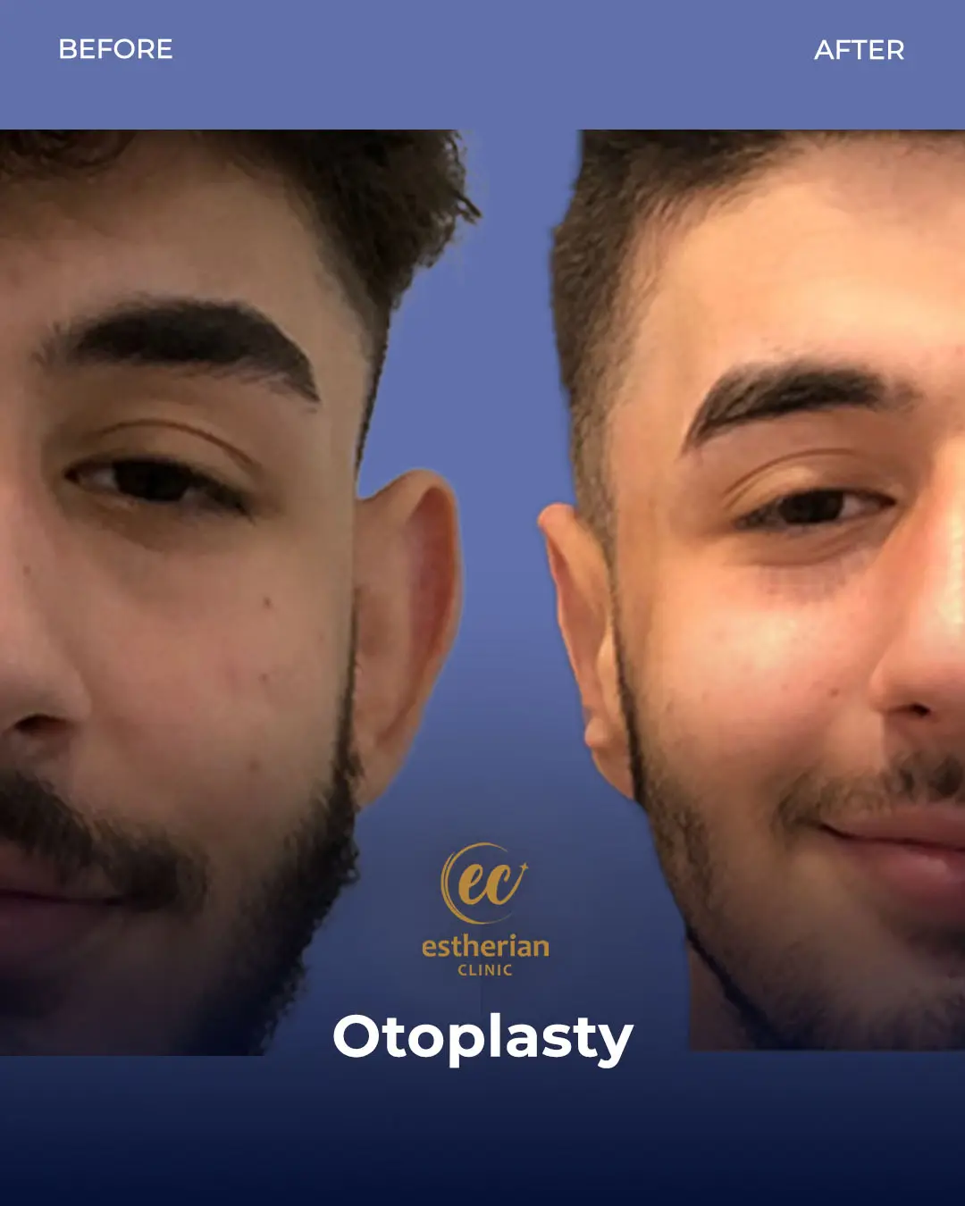 Otoplasty Before and After by the Estherian Clinic