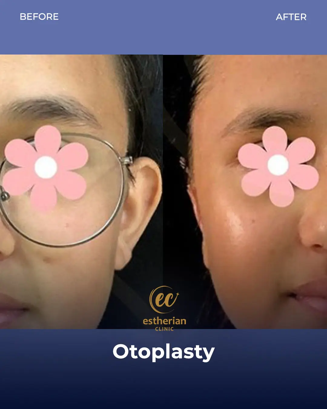 Otoplasty Before and After by the Estherian Clinic