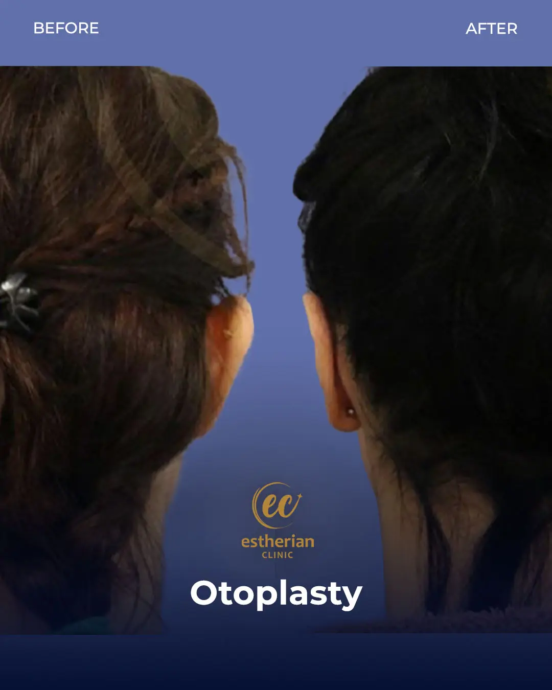 Otoplasty Before and After by the Estherian Clinic