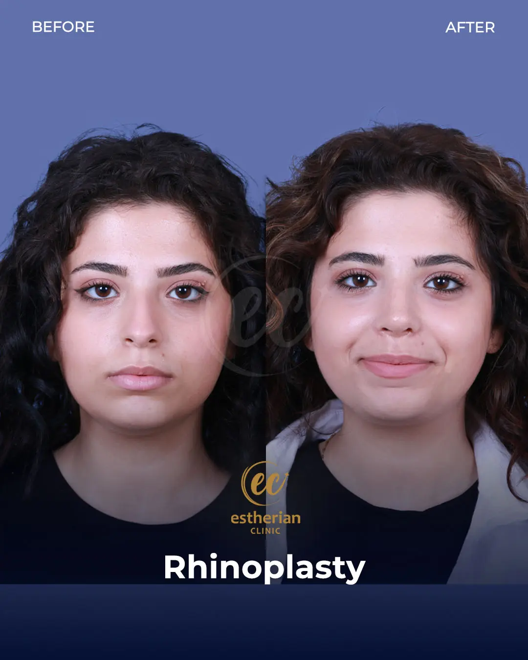 Rhinoplasty Before and After by the Estherian Clinic