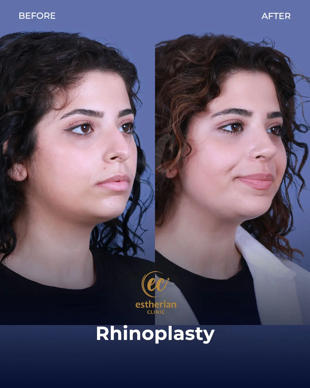 Rhinoplasty Before and After by the Estherian Clinic