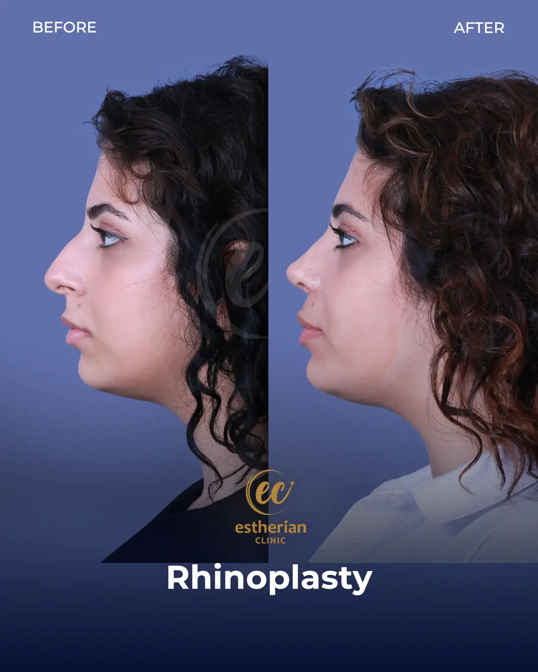 Rhinoplasty Before and After by the Estherian Clinic