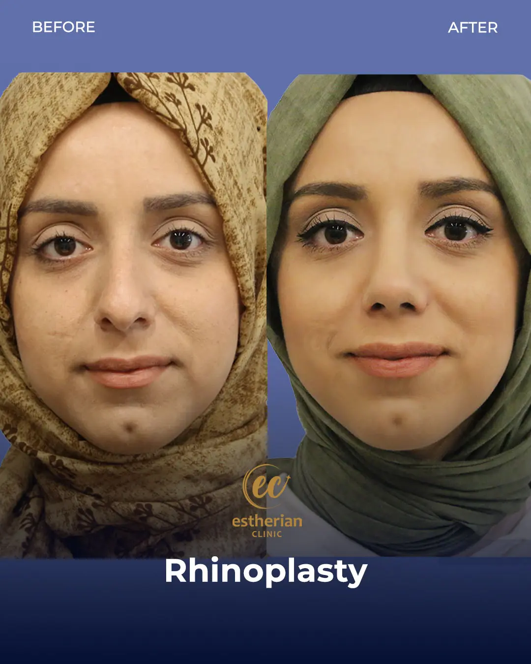 Rhinoplasty Before and After by the Estherian Clinic