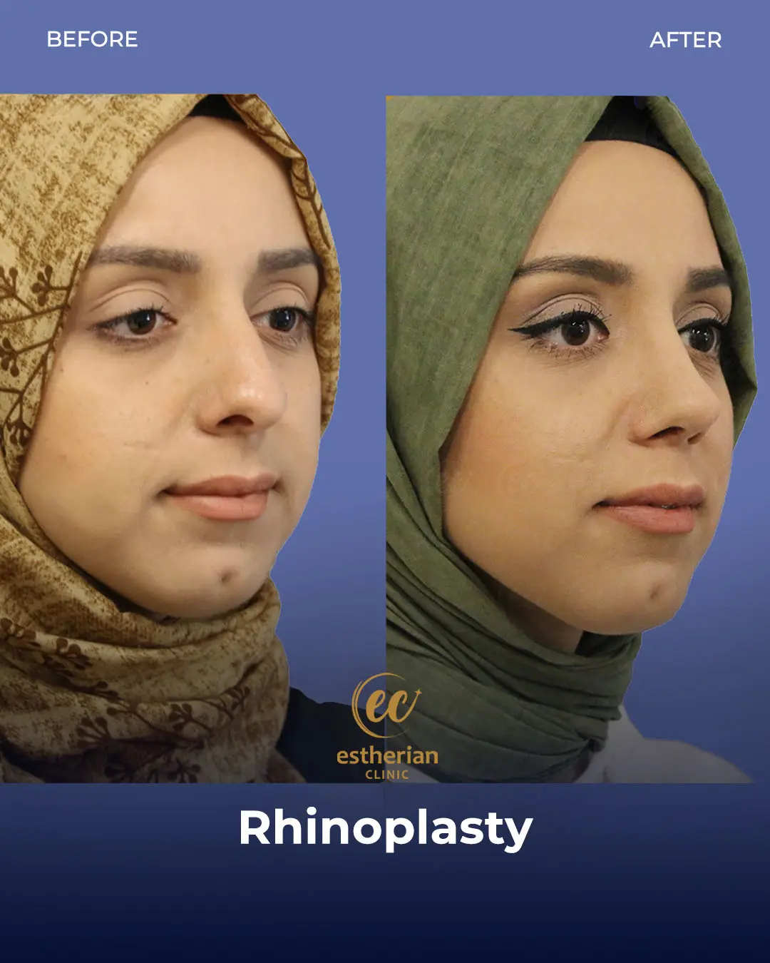 Rhinoplasty Before and After by the Estherian Clinic