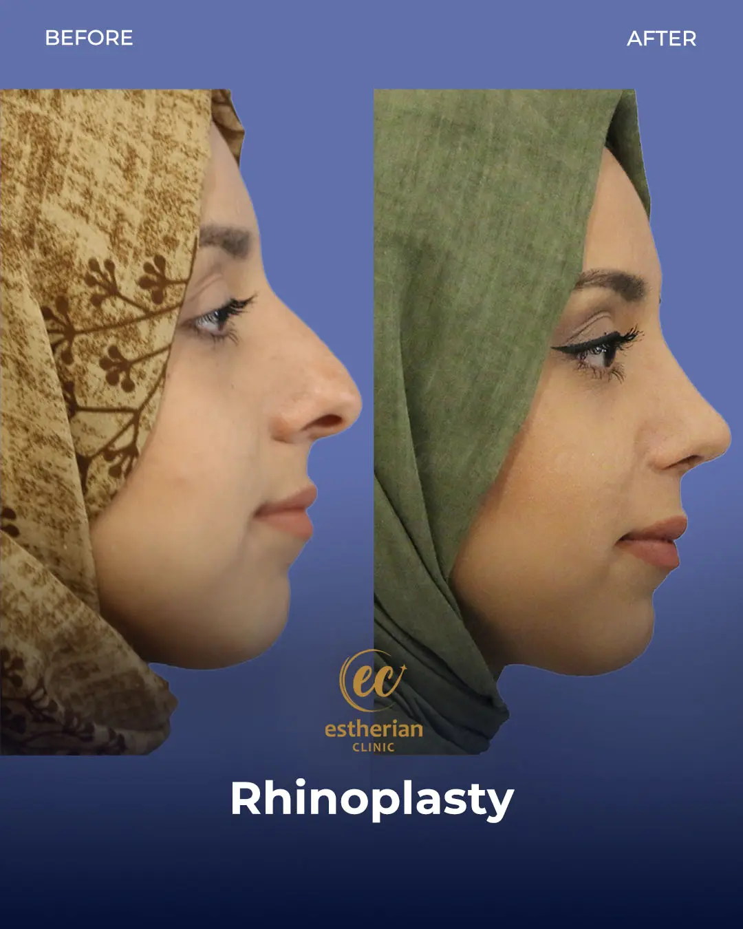 Rhinoplasty Before and After by the Estherian Clinic
