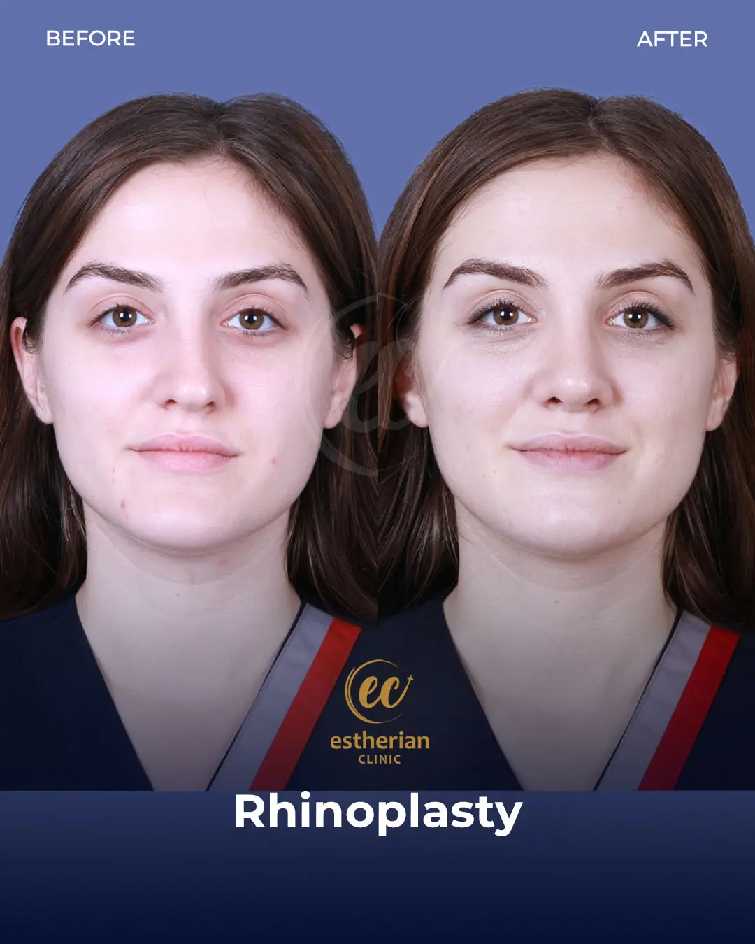 Rhinoplasty Before and After by the Estherian Clinic