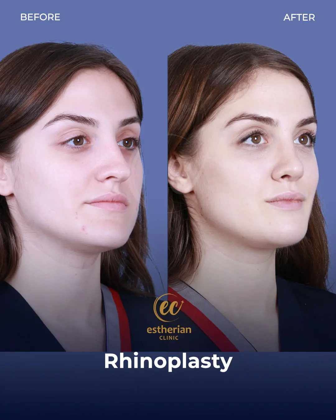 Rhinoplasty Before and After by the Estherian Clinic