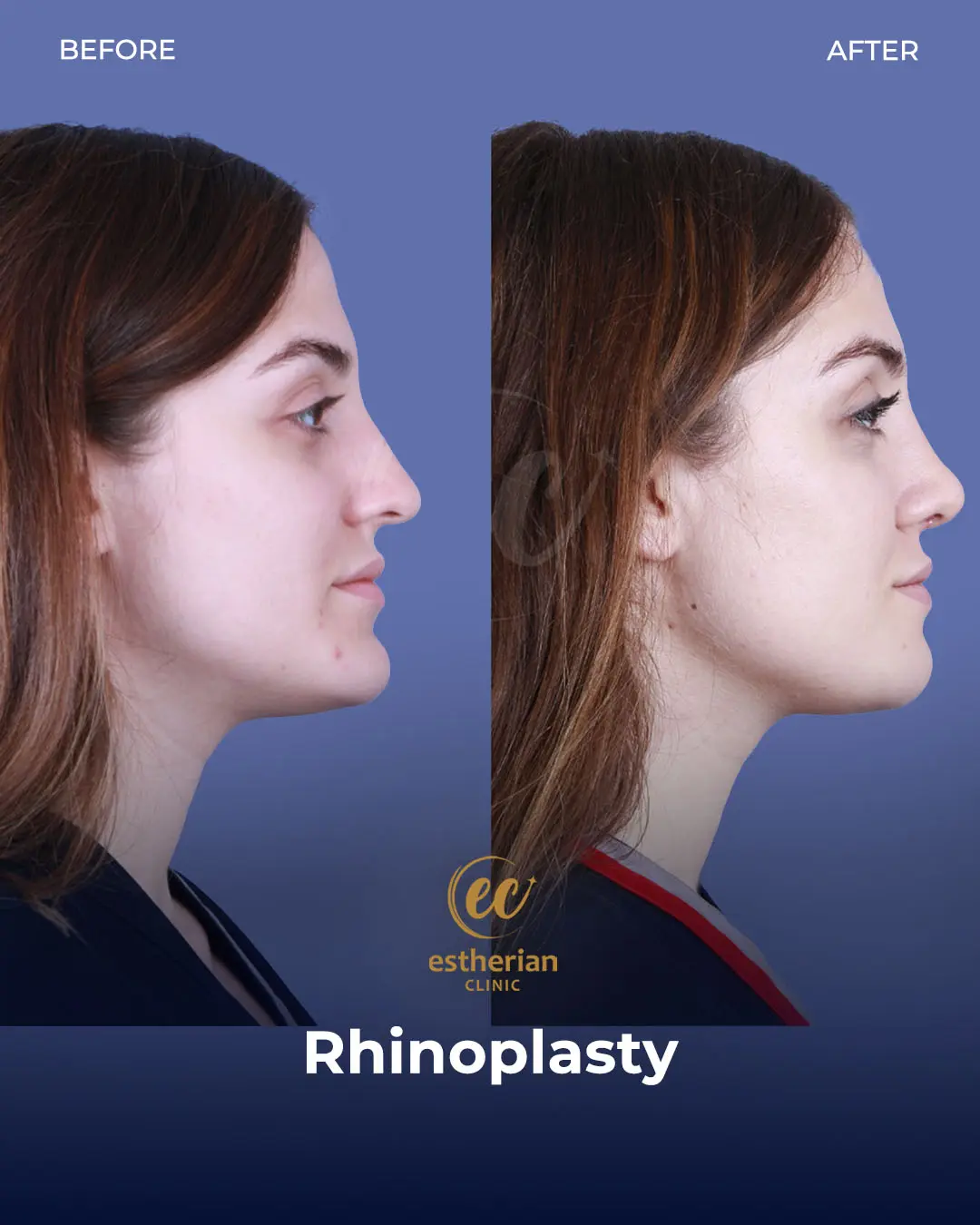 Rhinoplasty Before and After by the Estherian Clinic