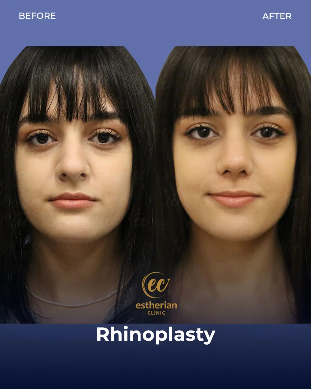 Rhinoplasty Before and After by the Estherian Clinic
