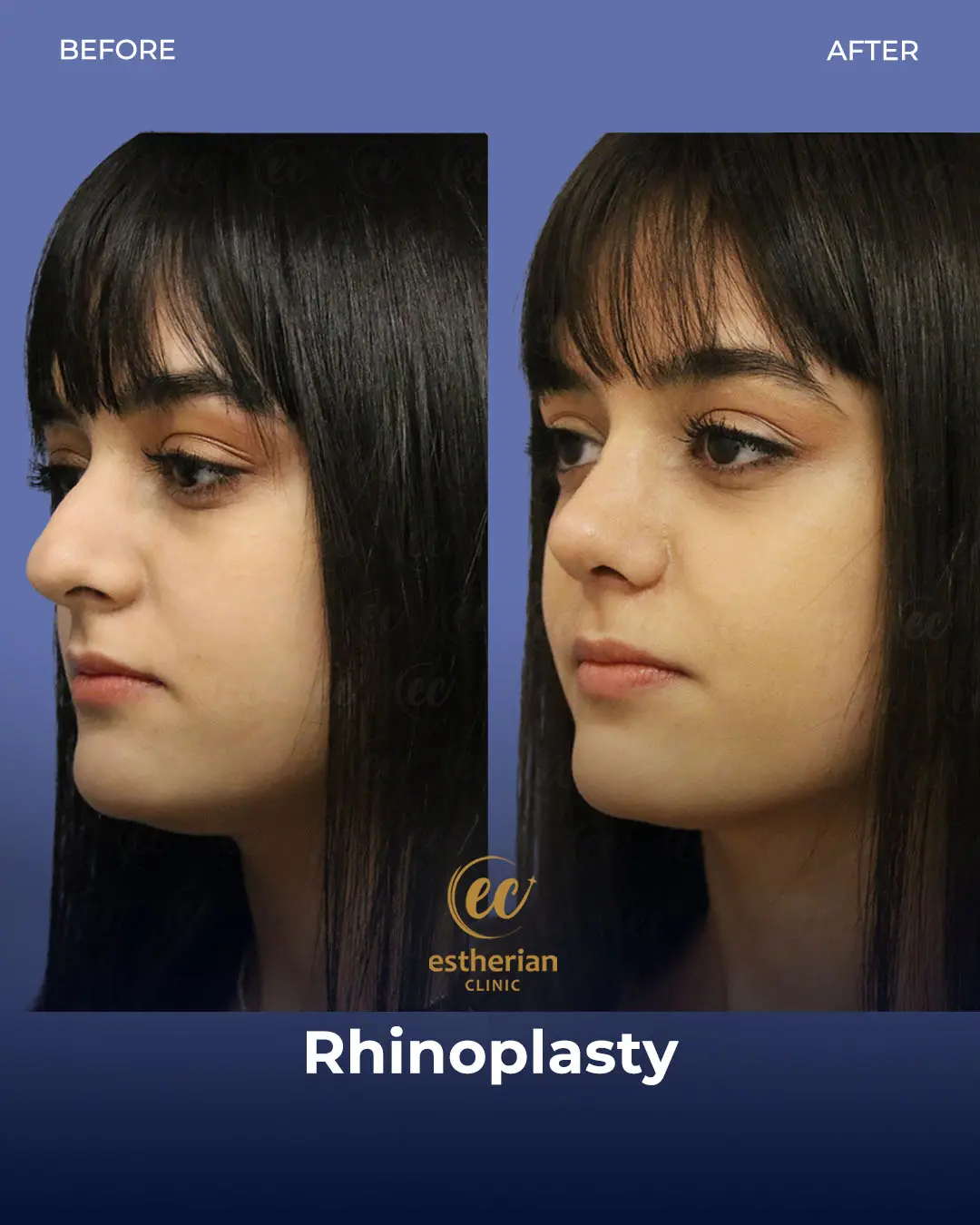 Rhinoplasty Before and After by the Estherian Clinic