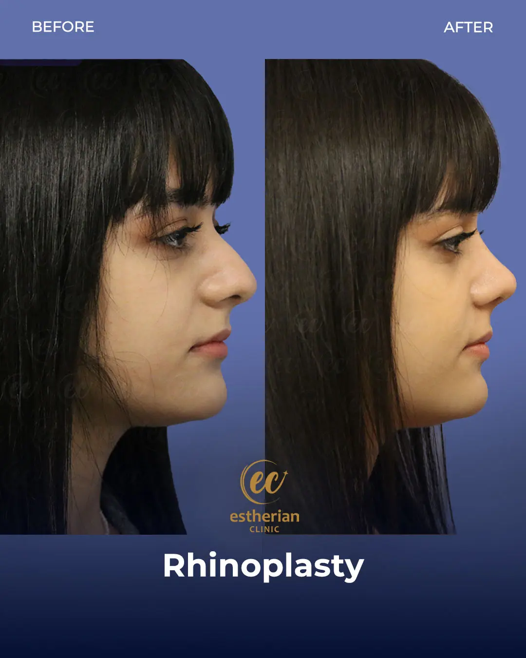 Rhinoplasty Before and After by the Estherian Clinic