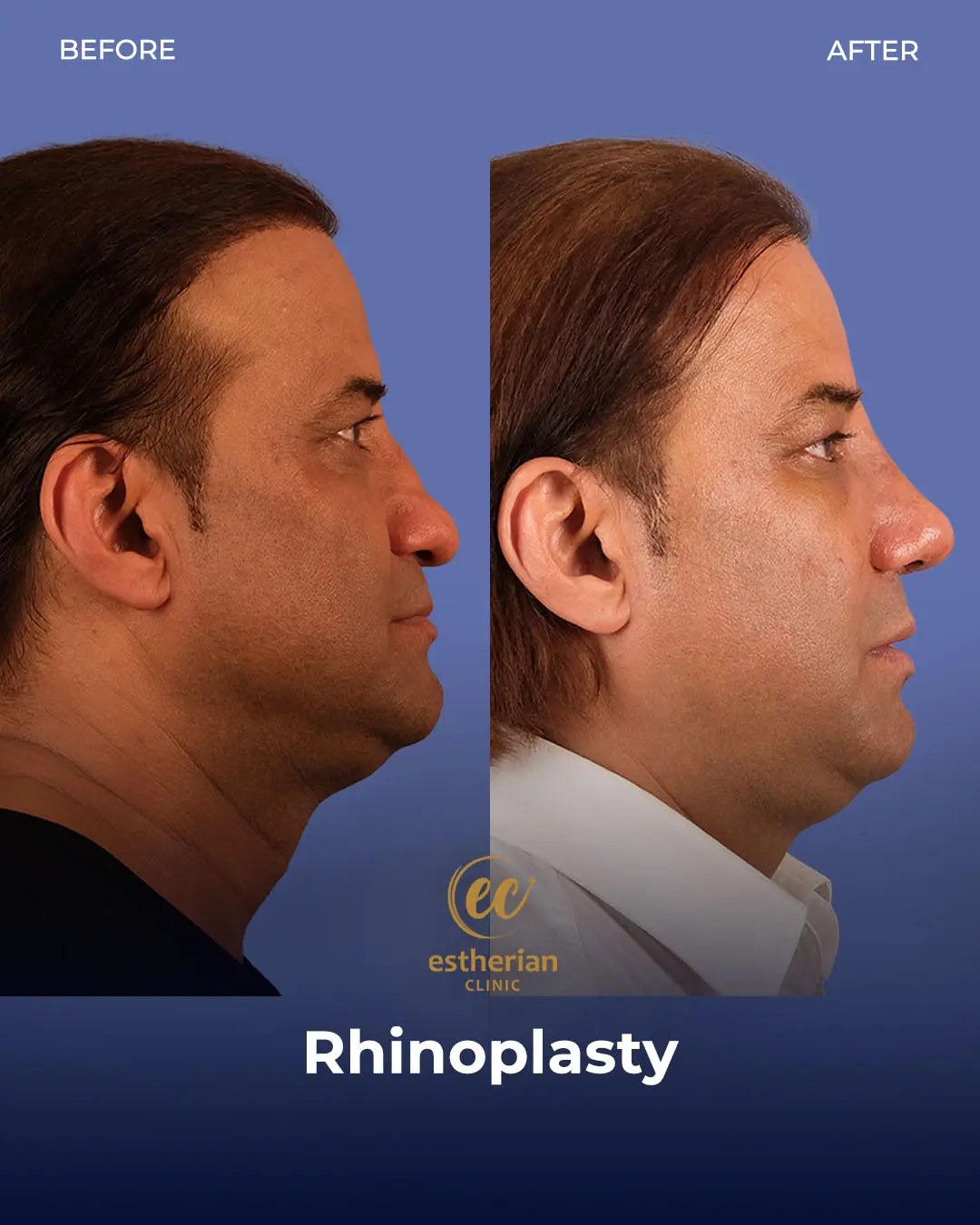 Rhinoplasty Before and After by the Estherian Clinic