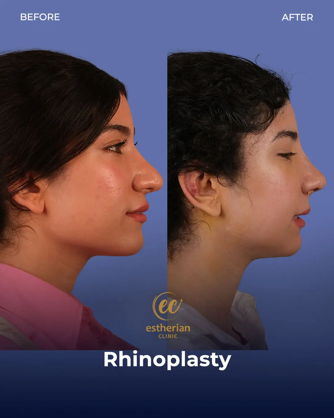 Rhinoplasty Before and After by the Estherian Clinic