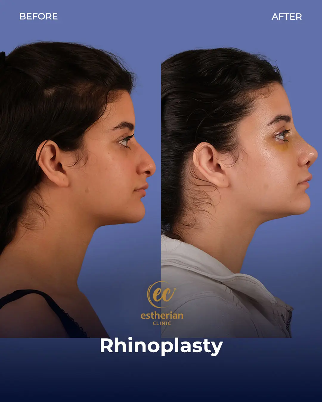 Rhinoplasty Before and After by the Estherian Clinic