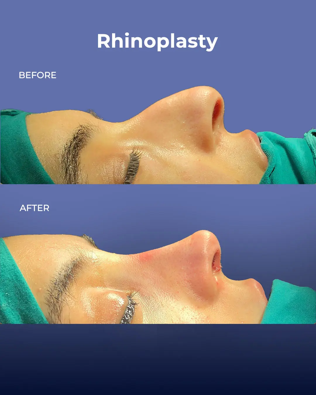 Rhinoplasty Before and After by the Estherian Clinic