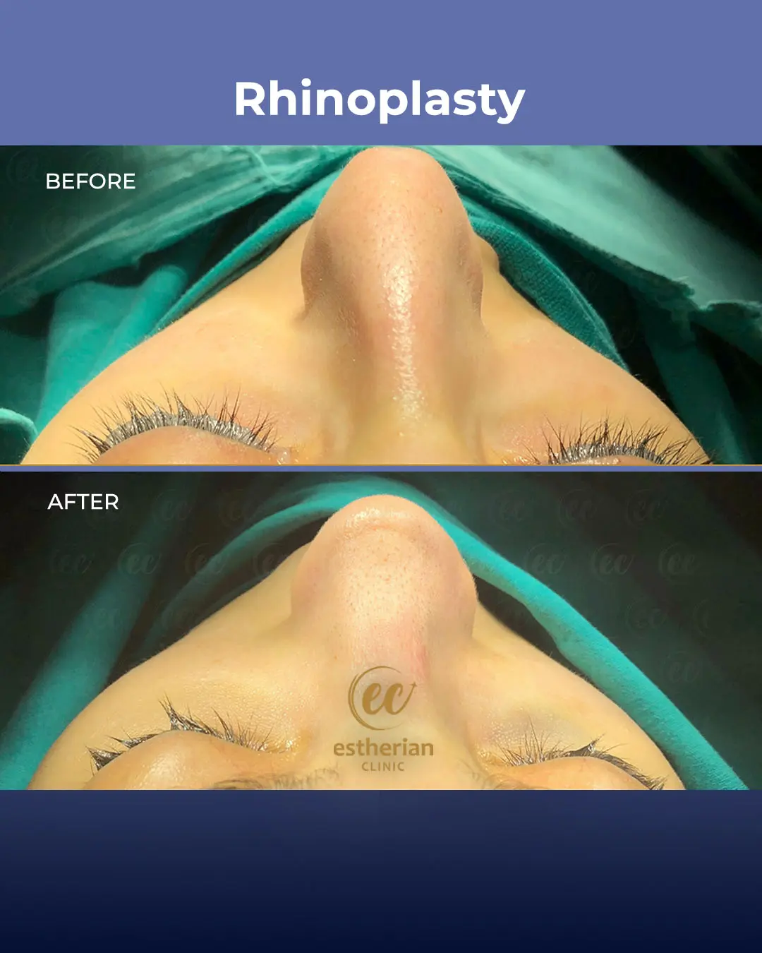 Rhinoplasty Before and After by the Estherian Clinic