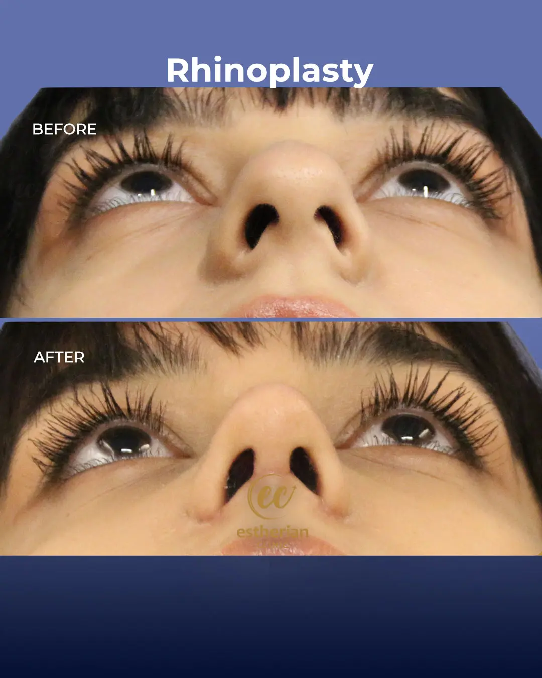 Rhinoplasty Before and After by the Estherian Clinic