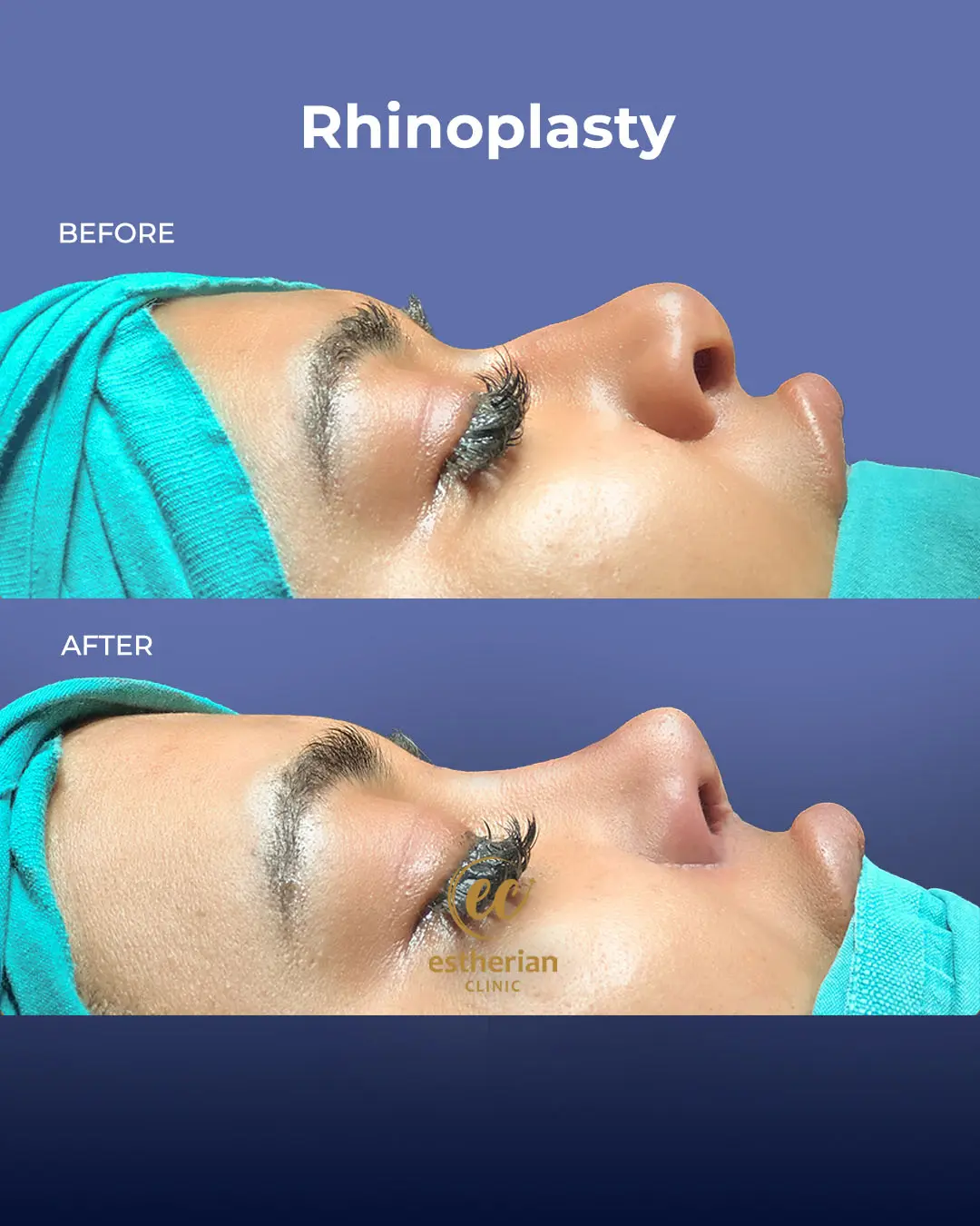Rhinoplasty Before and After by the Estherian Clinic