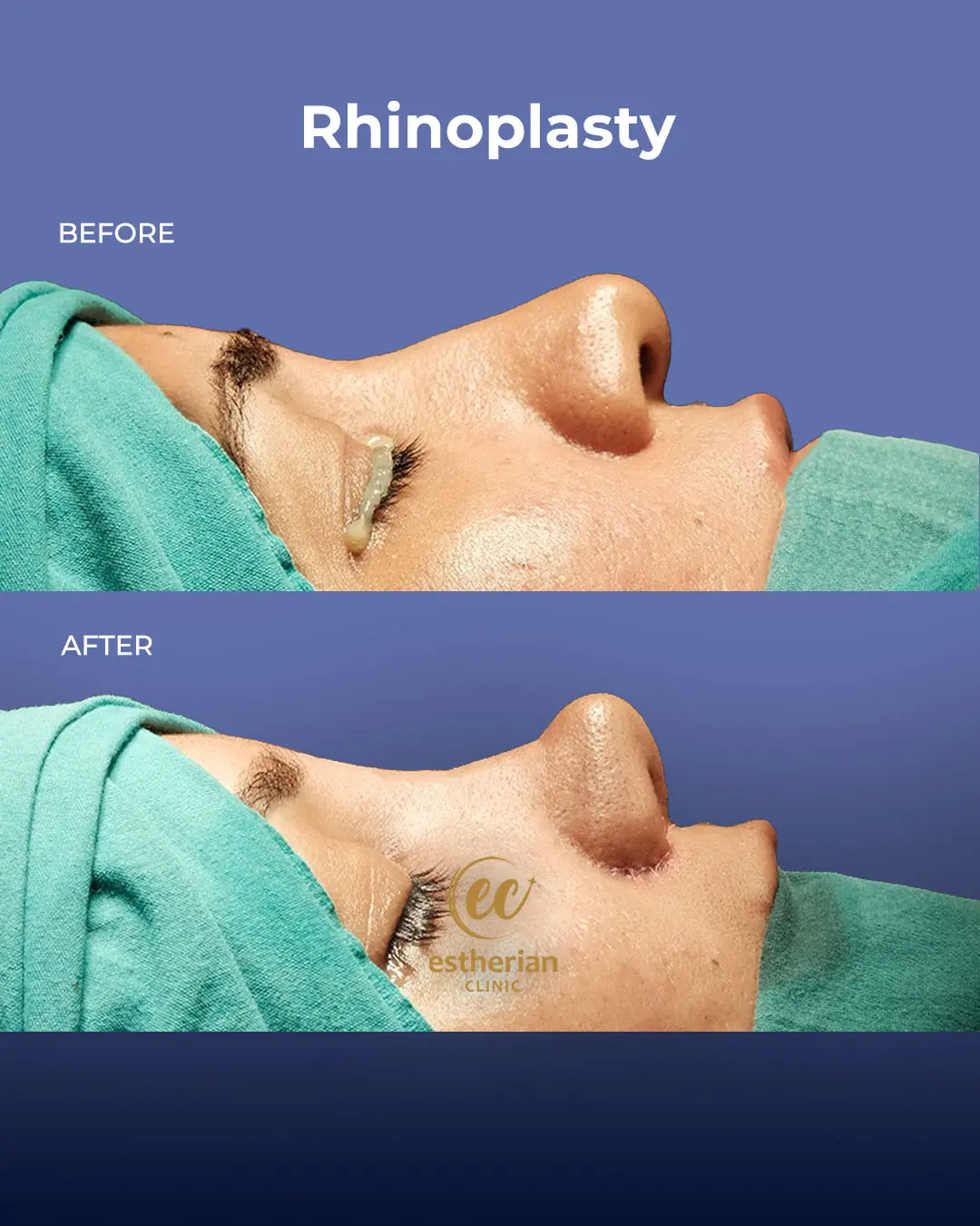 Rhinoplasty Before and After by the Estherian Clinic