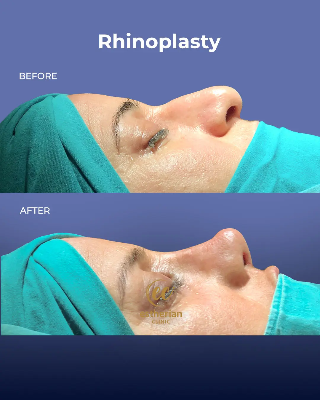 Rhinoplasty Before and After by the Estherian Clinic