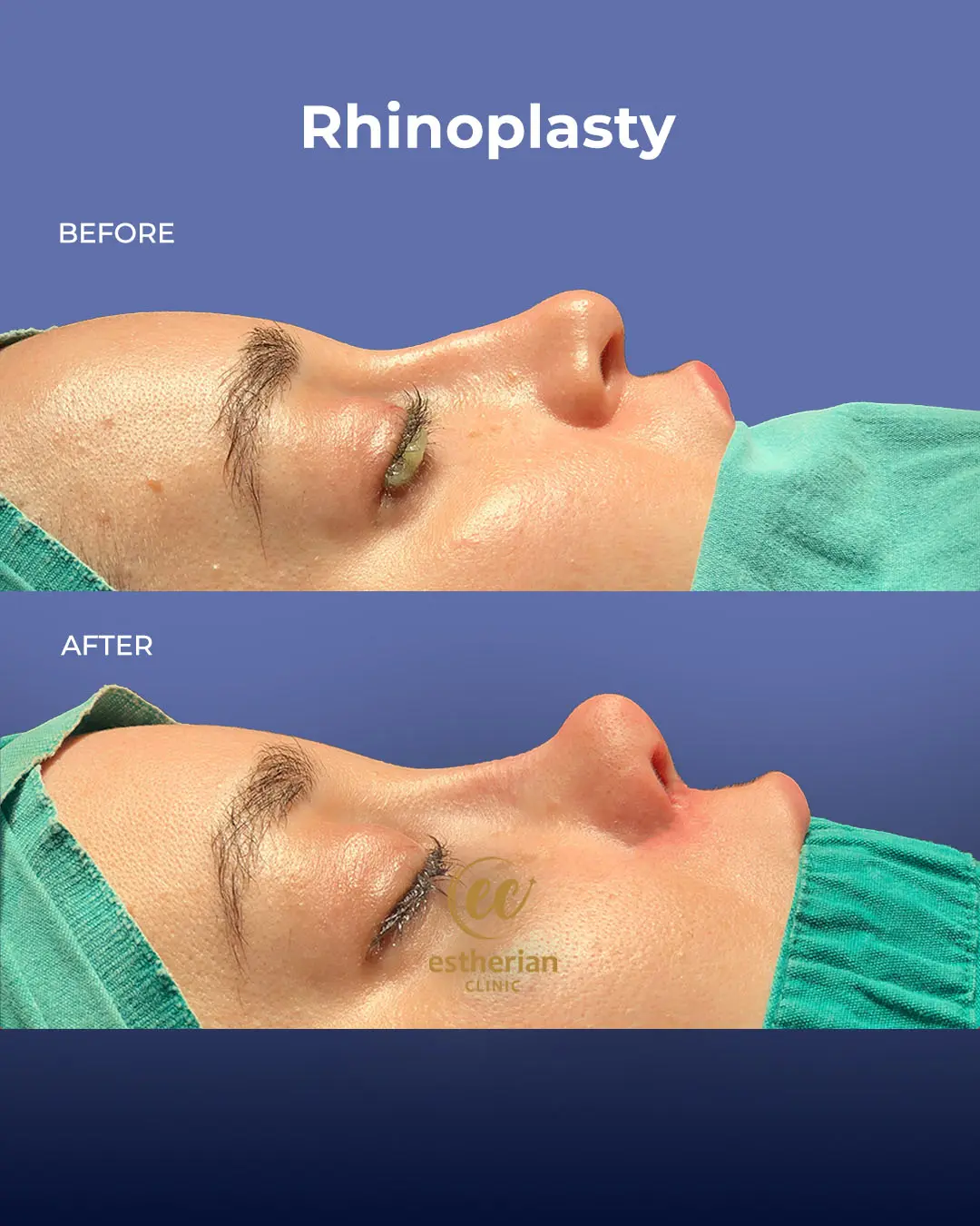 Rhinoplasty Before and After by the Estherian Clinic
