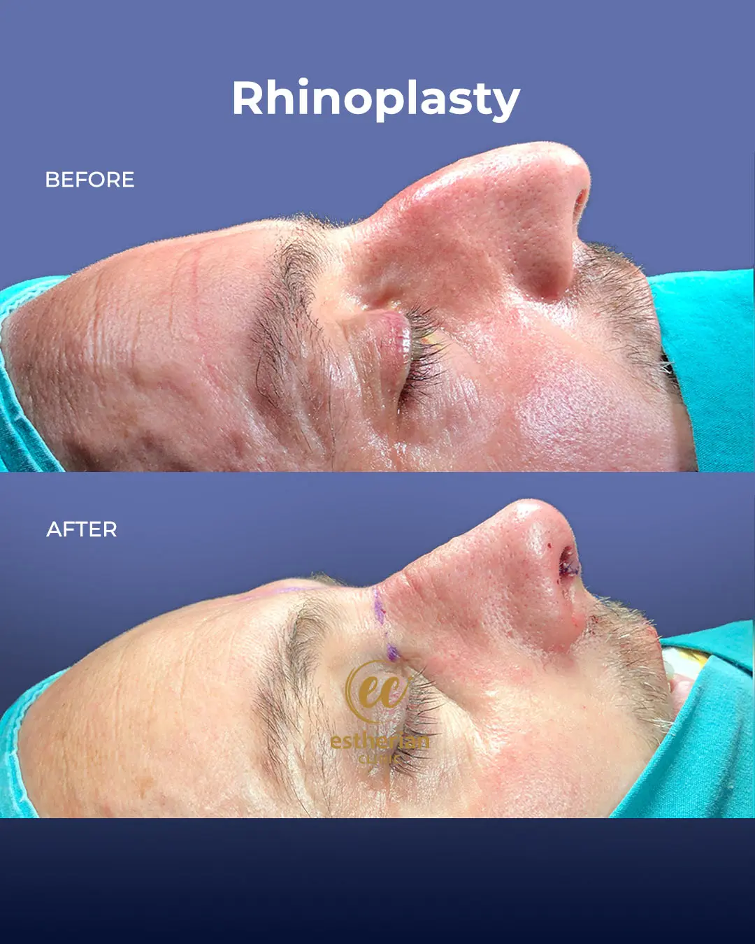 Rhinoplasty Before and After by the Estherian Clinic